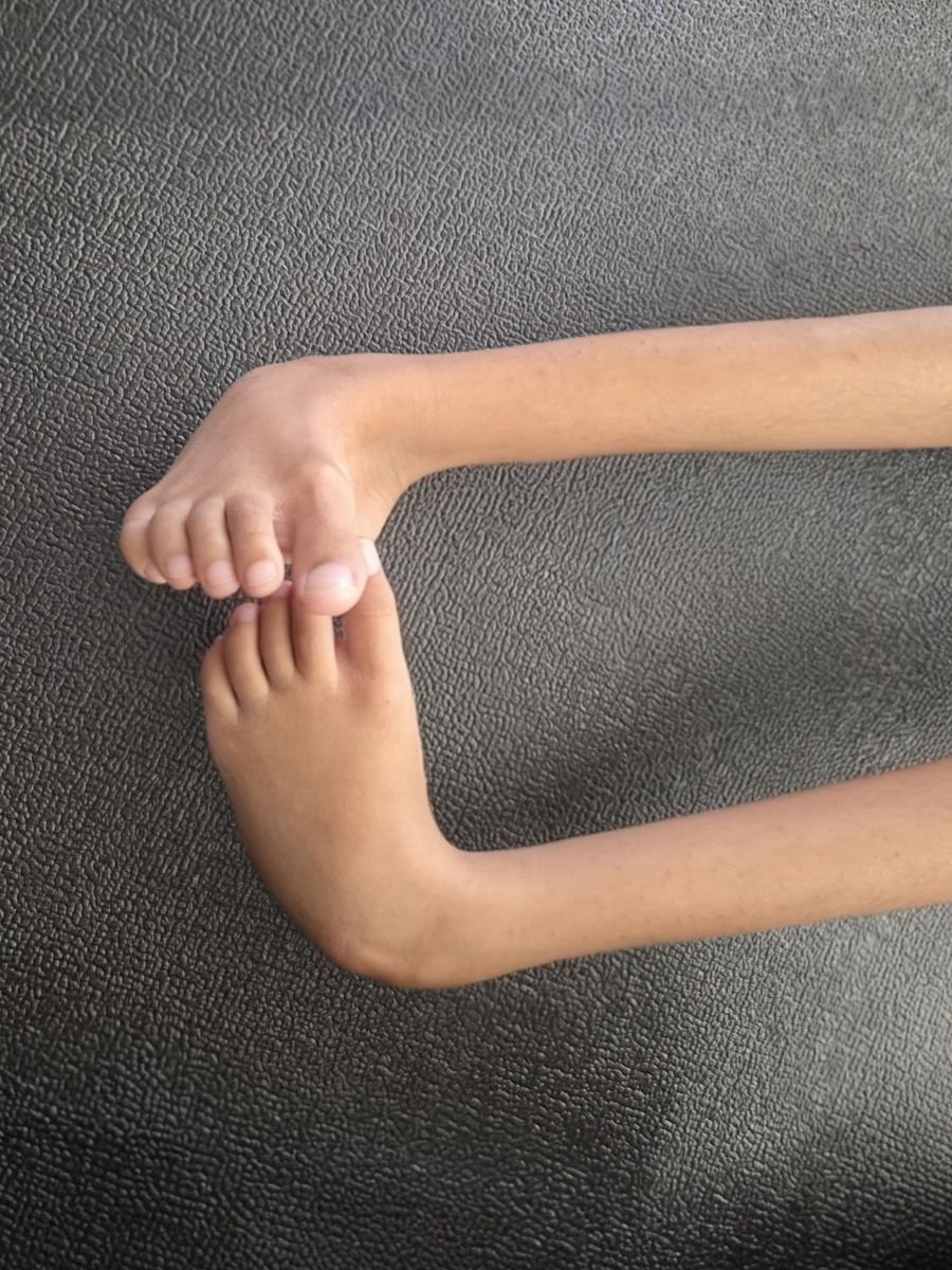 Before treatment at Kairos Physio