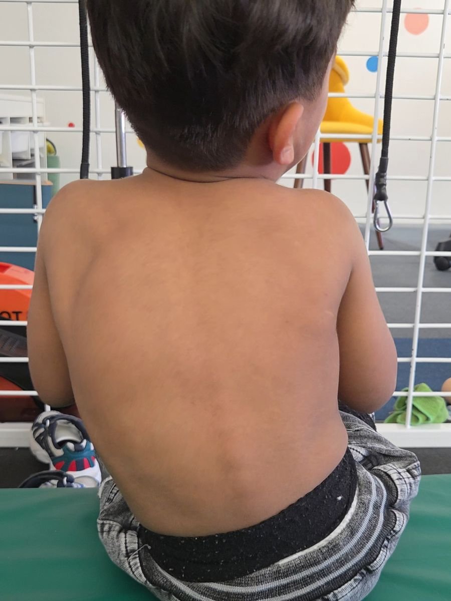 Before treatment at Kairos Physio